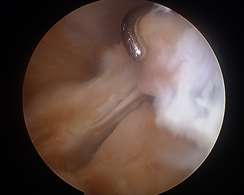 Meniscal Root Tear